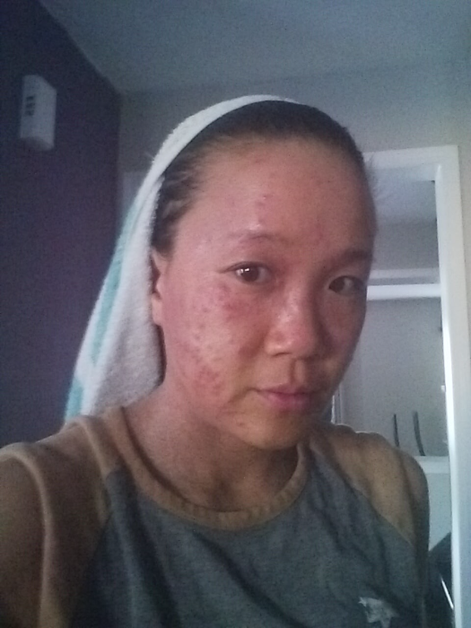 Abby before eczema recovery