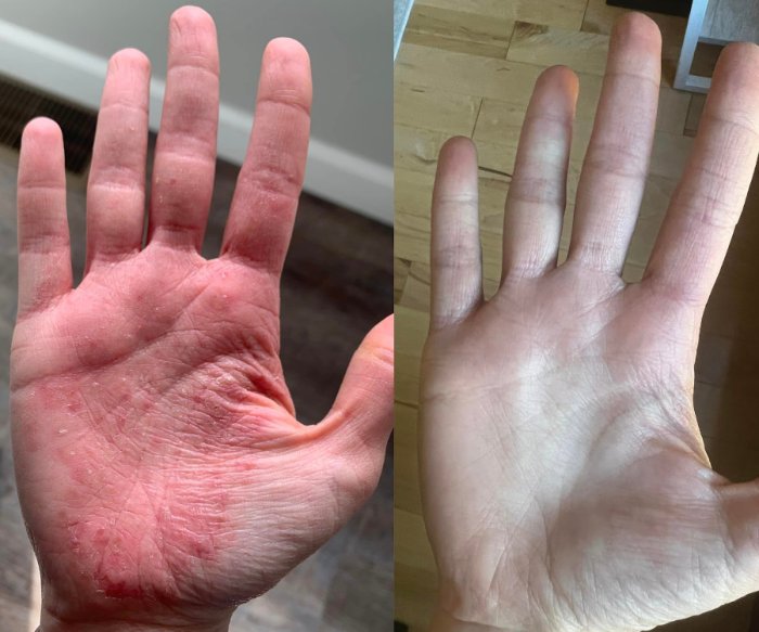 Client hand eczema transformation