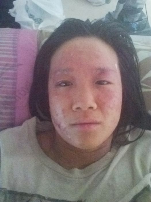 Abby before her eczema recovery