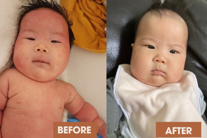 Baby eczema transformation
