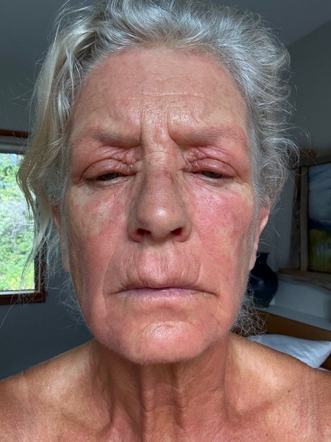 Client facial eczema before