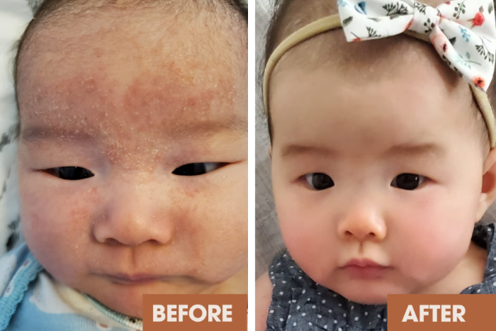 Baby facial eczema transformation