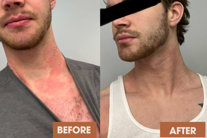 Client neck eczema transformation