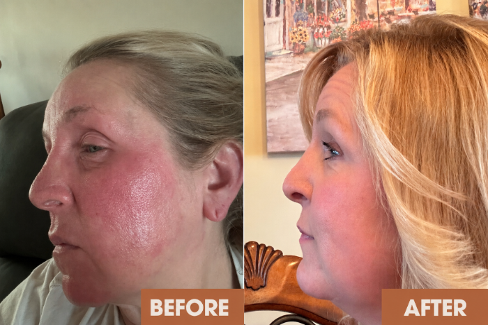 Client facial eczema transformation