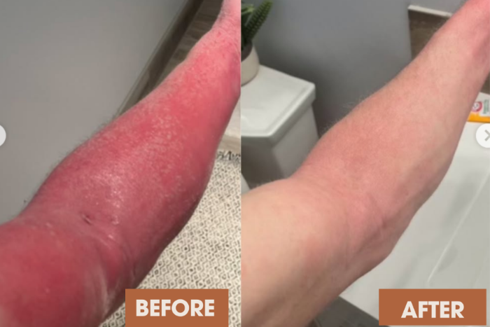 Client arm eczema transformation
