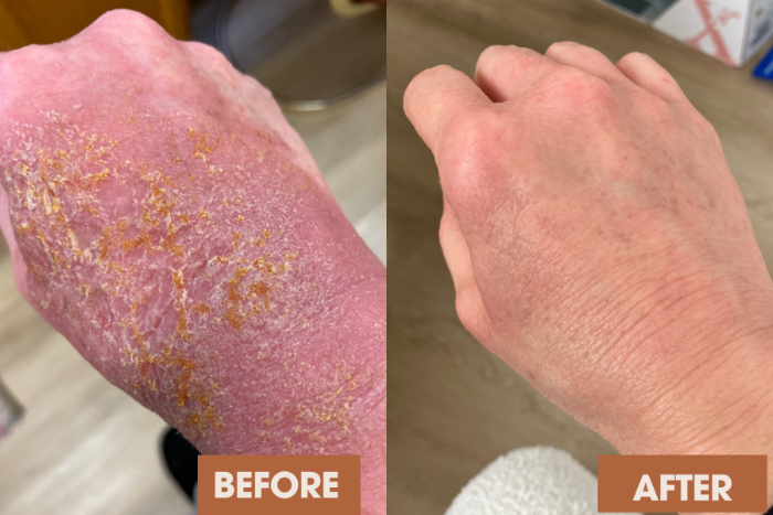 Client palm eczema transformation